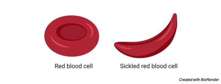 Sickle cell anemia - research tweet 2